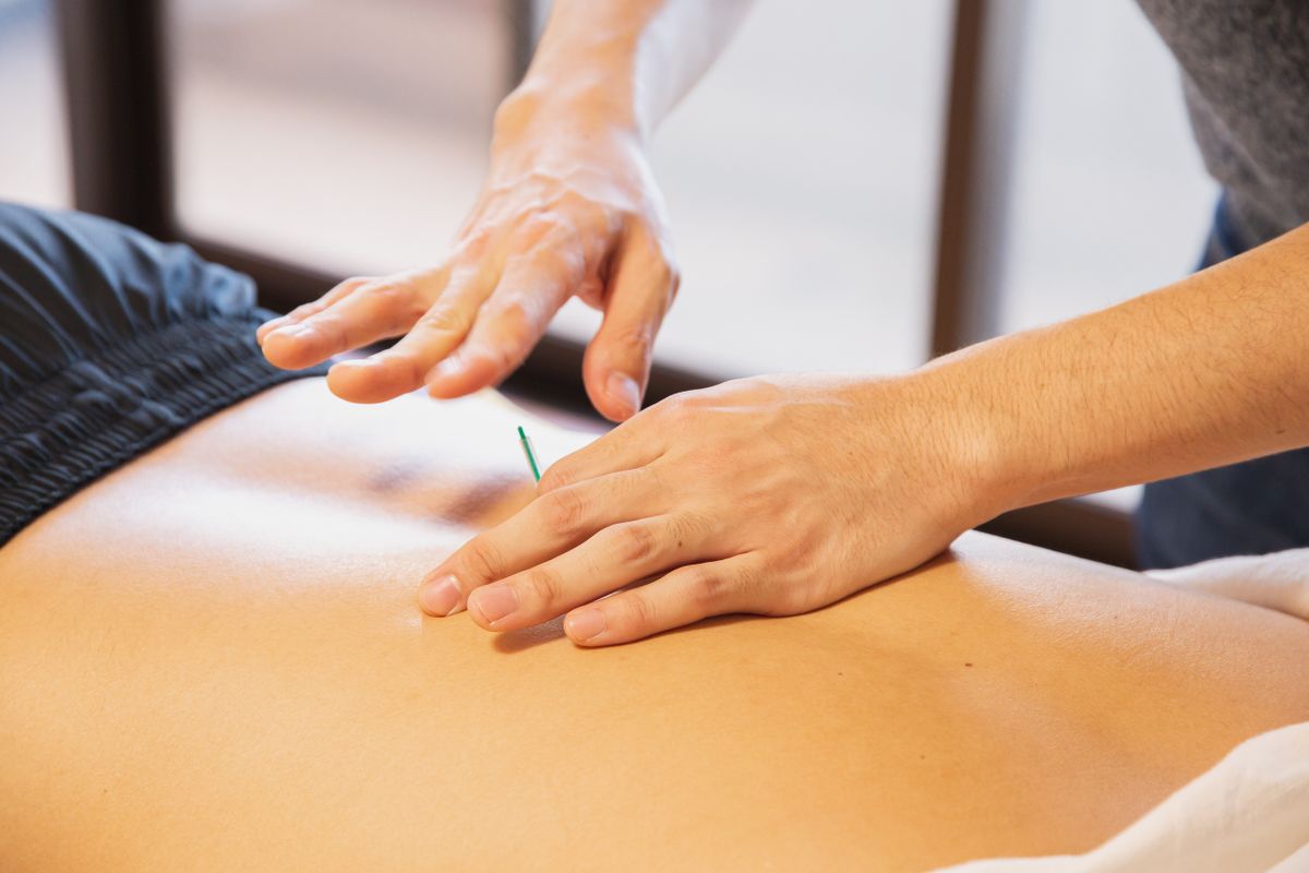 Dry Needling